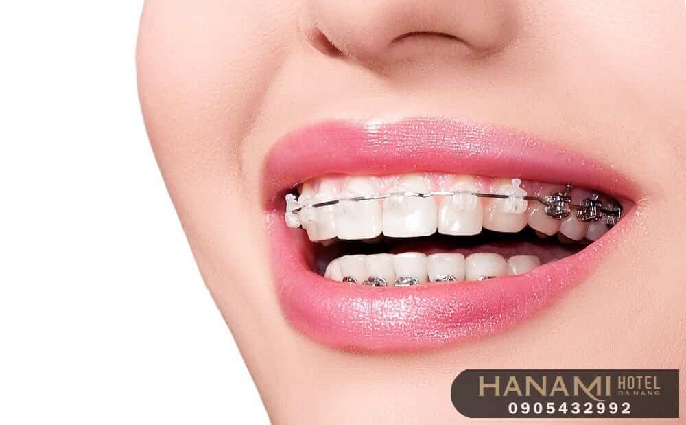 niềng răng uy tín ở Đà Nẵng