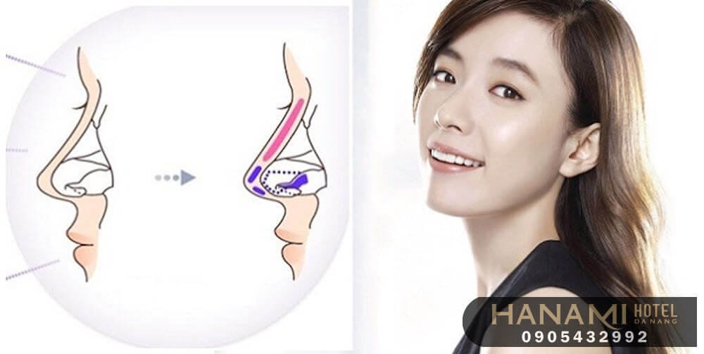 địa chỉ nâng mũi Đà Nẵng