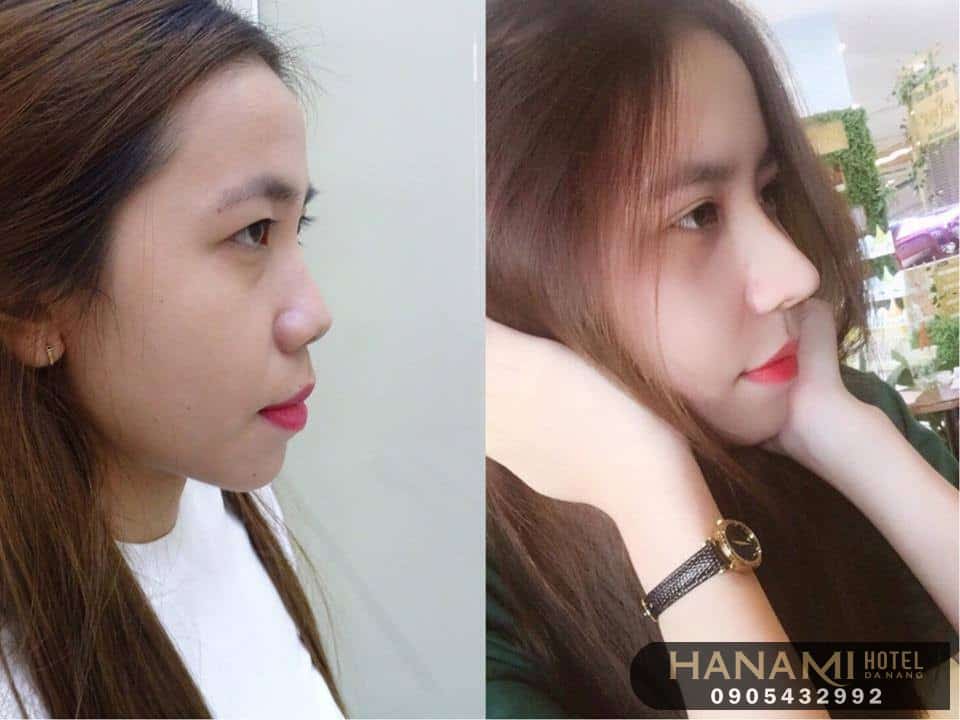 địa chỉ nâng mũi Đà Nẵng