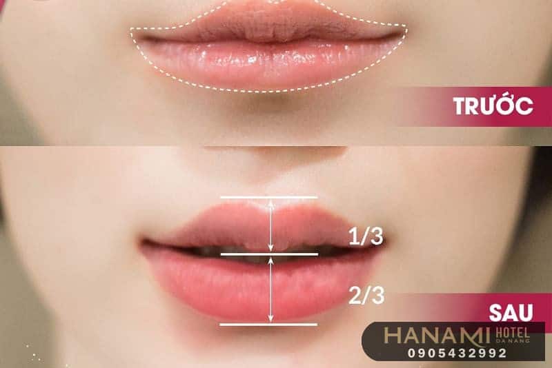 địa chỉ tiêm filler uy tín ở Đà Nẵng