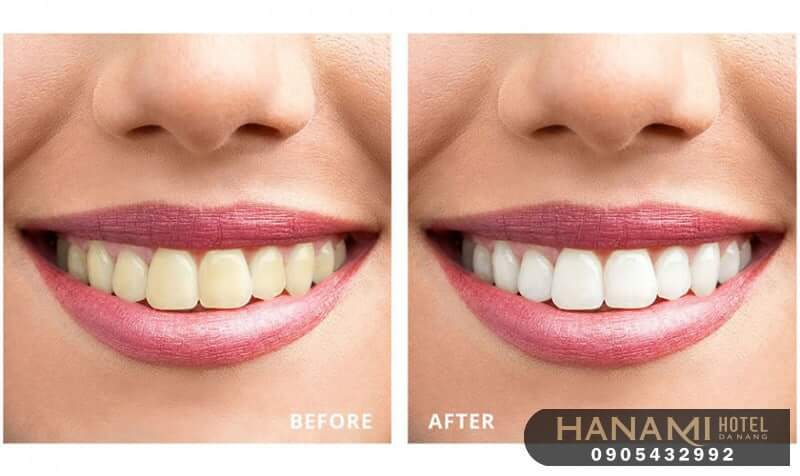 15 địa chỉ tẩy trắng răng ở Đà Nẵng an toàn, hiệu quả nhất 7 tẩy trắng răng ở đà nẵng