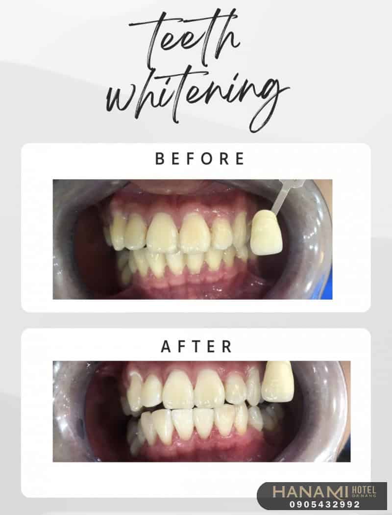 15 địa chỉ tẩy trắng răng ở Đà Nẵng an toàn, hiệu quả nhất 10 tẩy trắng răng ở đà nẵng