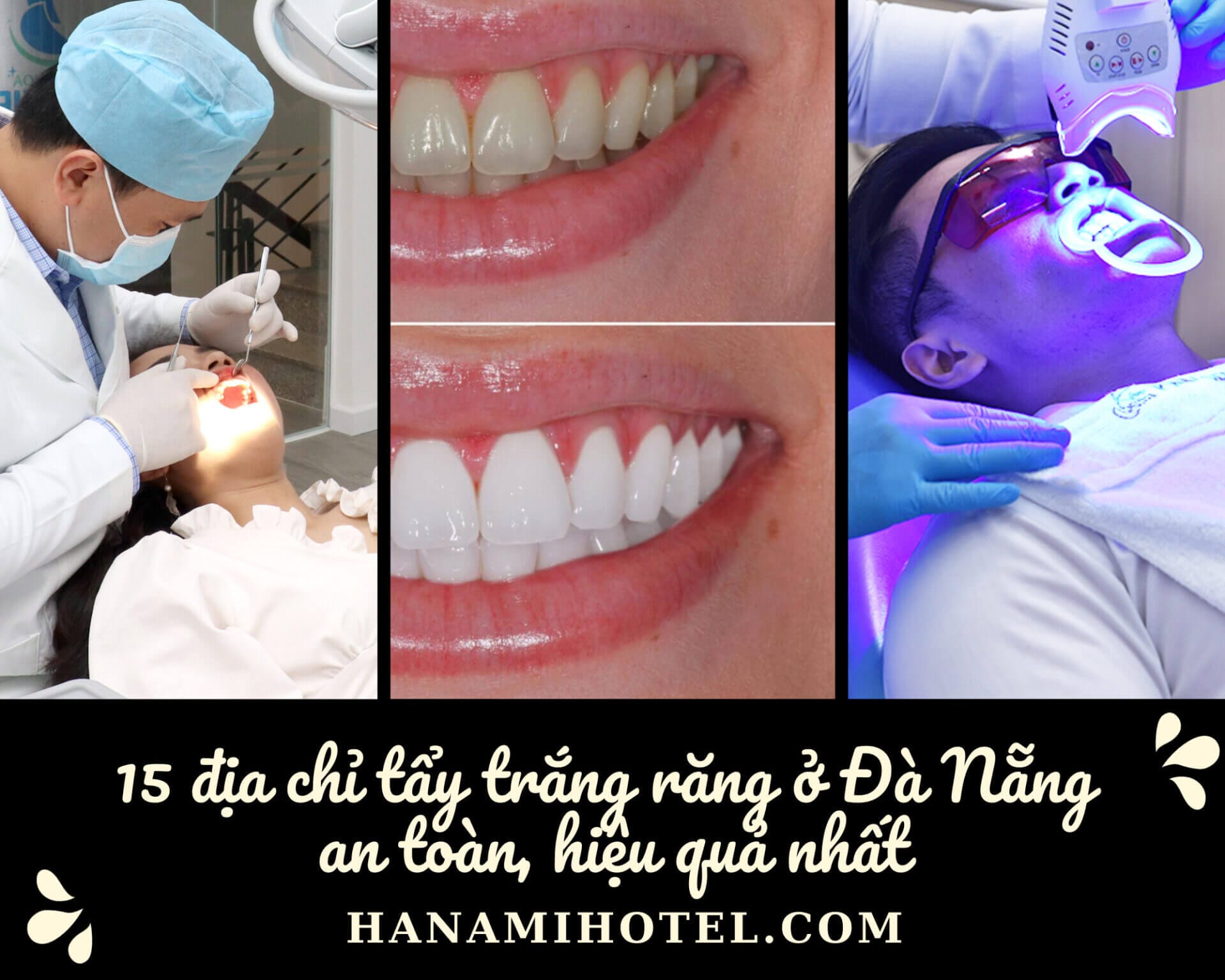 15 địa chỉ tẩy trắng răng ở Đà Nẵng an toàn, hiệu quả nhất 1 tẩy trắng răng ở đà nẵng
