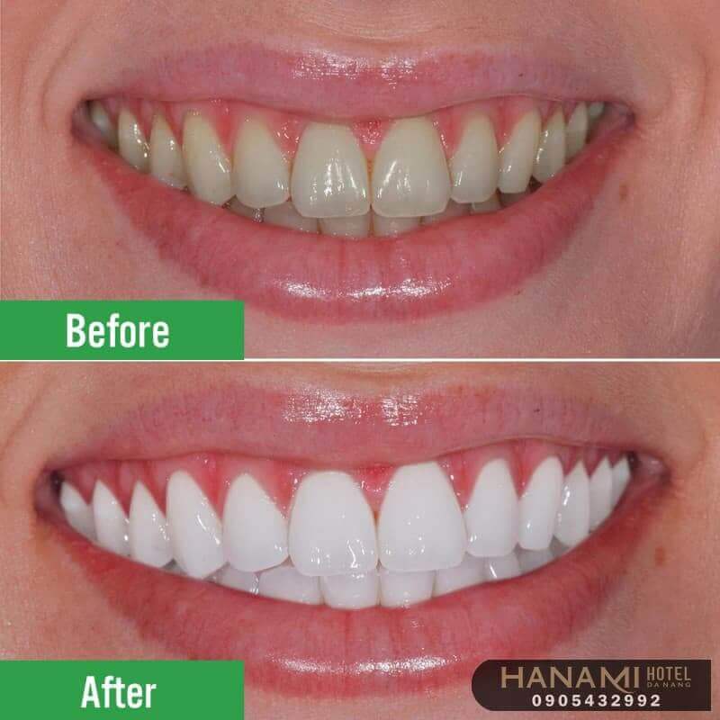 Top 15 best addresses for teeth whitening in Da Nang, reviews by Hanami 10 teeth whitening in da nang