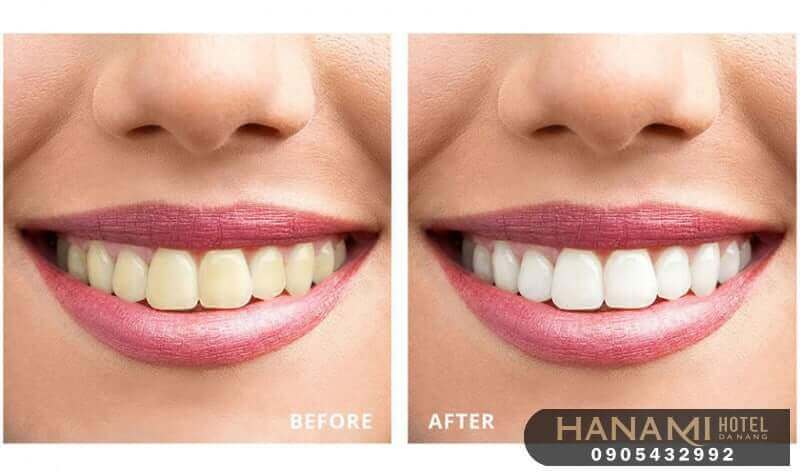 Top 15 best addresses for teeth whitening in Da Nang, reviews by Hanami 1 teeth whitening in da nang