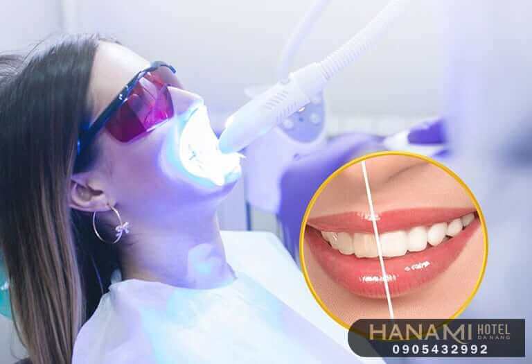 Top 15 best addresses for teeth whitening in Da Nang, reviews by Hanami 11 teeth whitening in da nang