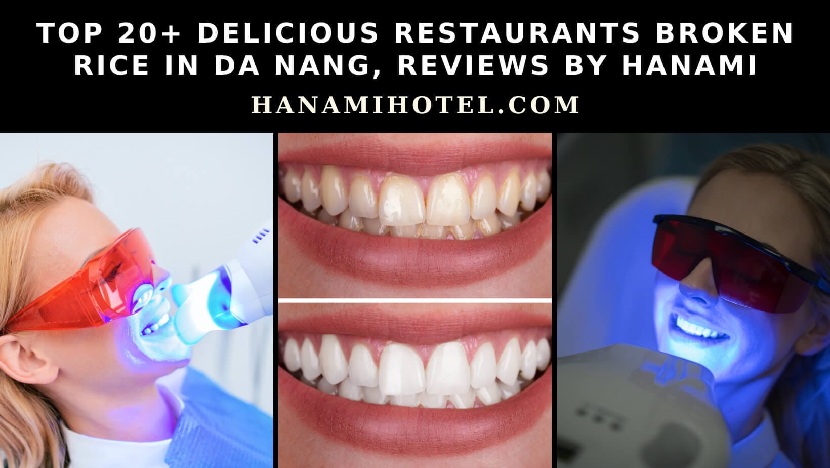 Top 15 best addresses for teeth whitening in Da Nang, reviews by Hanami 2 teeth whitening in da nang