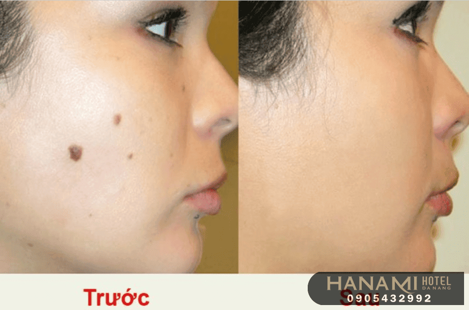 best places for mole remover in da nang