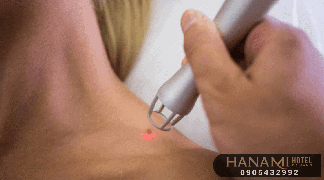 10 địa điểm tẩy nốt ruồi Đà Nẵng uy tín nhất 6 tẩy nốt ruồi đà nẵng