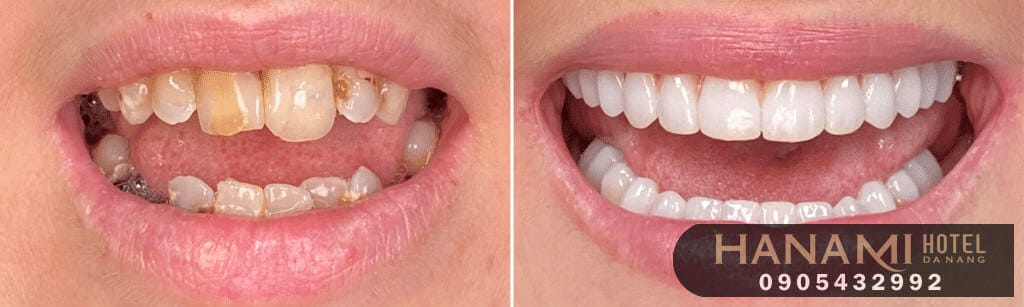 bọc răng sứ ở Đà Nẵng