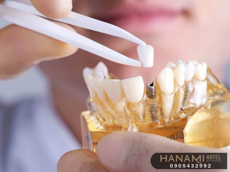 bọc răng sứ ở Đà Nẵng