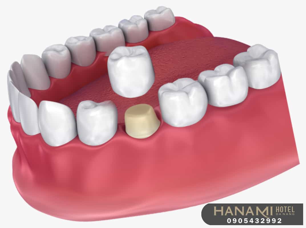 bọc răng sứ ở Đà Nẵng