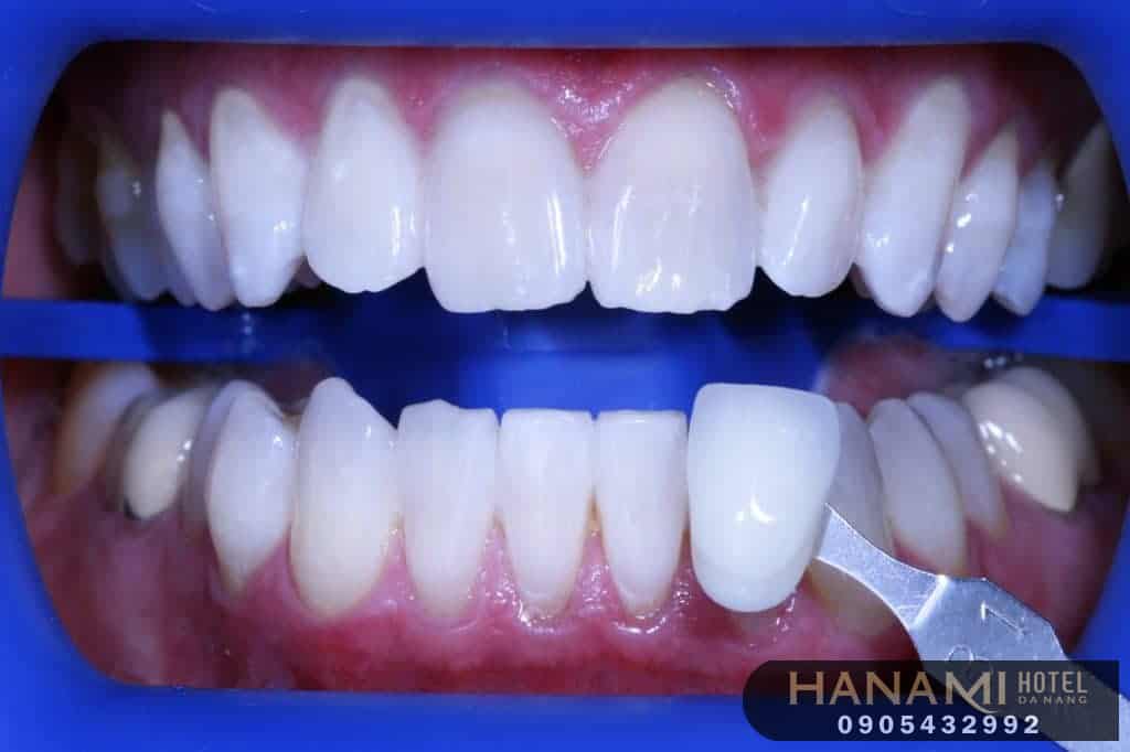 bọc răng sứ ở Đà Nẵng