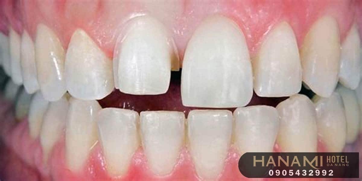 bọc răng sứ ở Đà Nẵng
