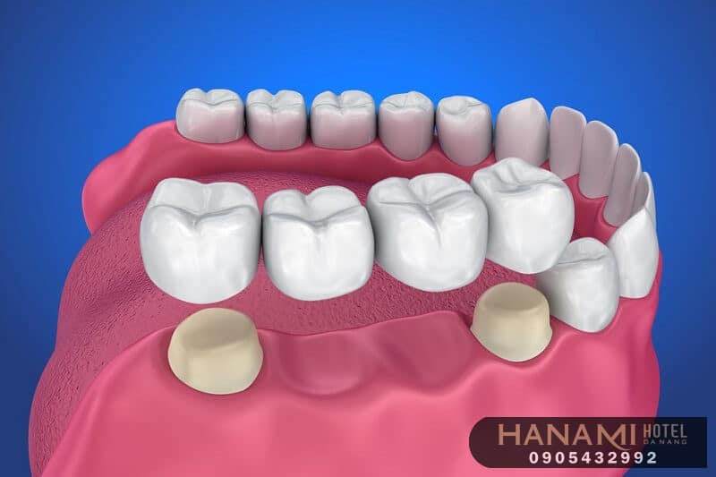 bọc răng sứ ở Đà Nẵng