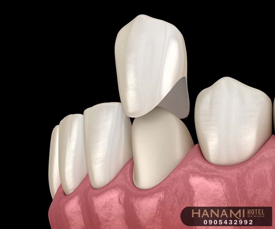 bọc răng sứ ở Đà Nẵng