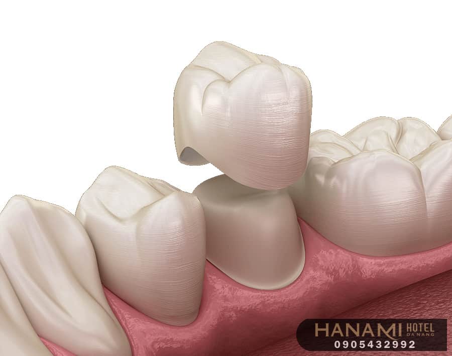 bọc răng sứ ở Đà Nẵng