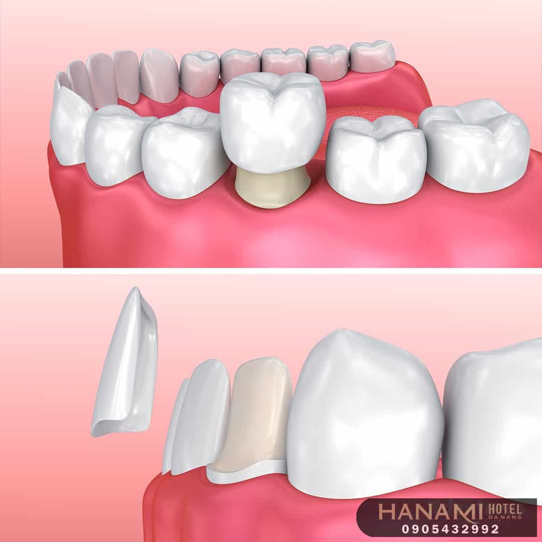 bọc răng sứ ở Đà Nẵng