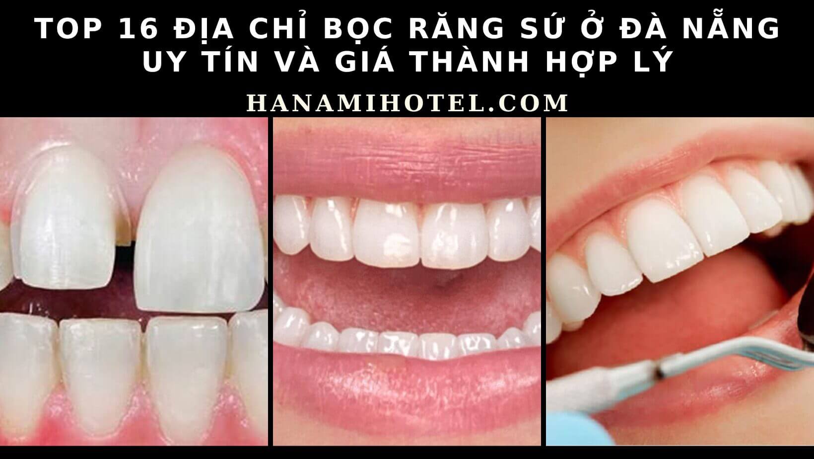Bọc Răng Sứ Ở Đà Nẵng
