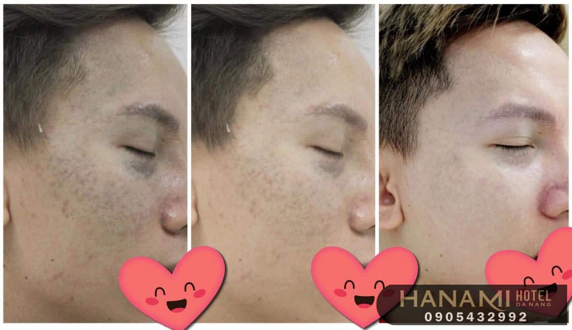 xóa bớt bẩm sinh ở Đà Nẵng