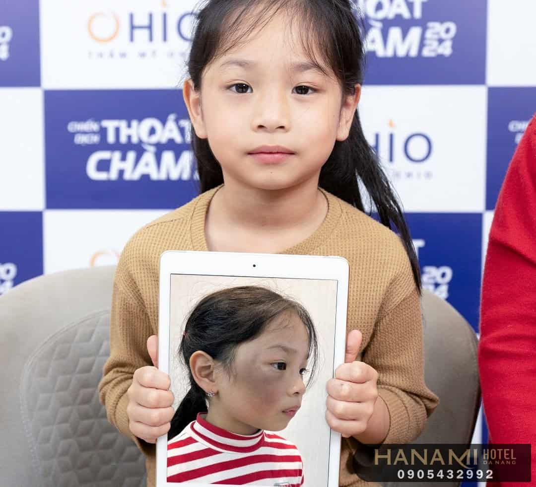 xóa bớt bẩm sinh ở Đà Nẵng