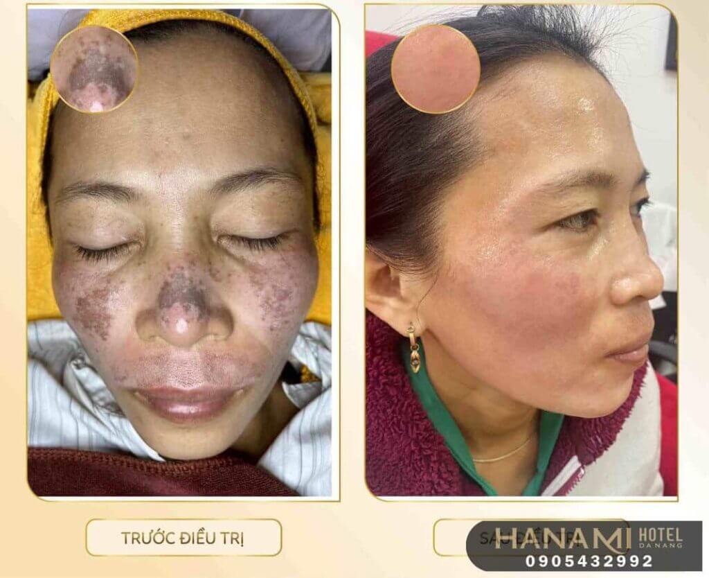 xóa bớt bẩm sinh ở Đà Nẵng