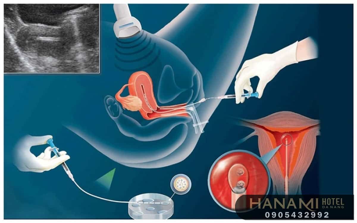 Phương pháp chữa vô sinh hiếm muộn